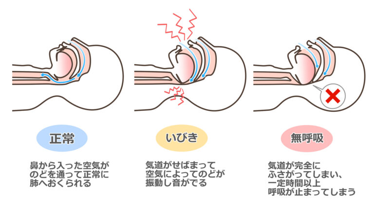 いびきが発生する原因